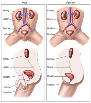 kidney stones in women